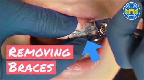 metal braces removal process